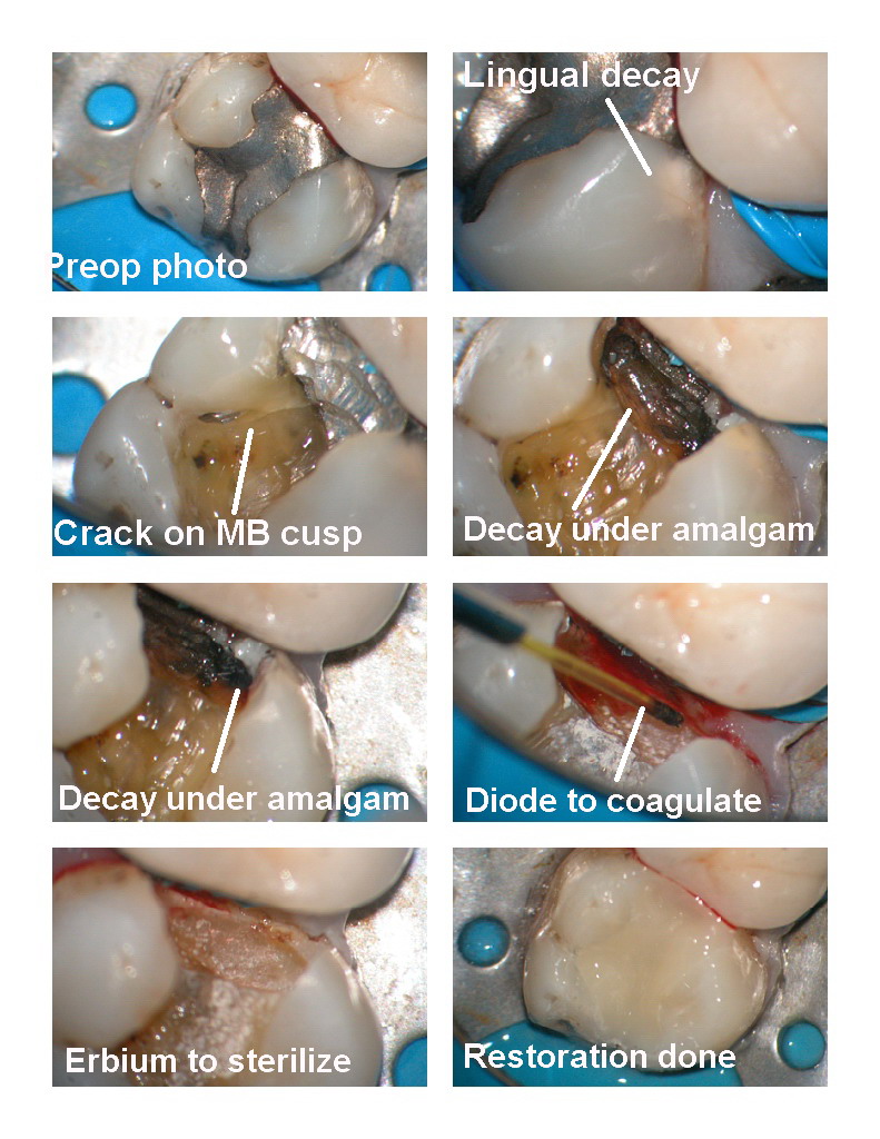 Cracked and fractured tooth.jpg